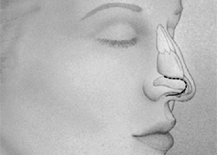 Drawing showing the incision line over the tip cartilages